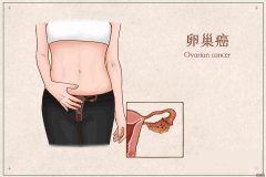 这是妇科最“狠”的癌症，一发现多为晚期!医生:早期无明显症状